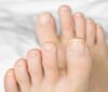 Natural remedies to treat thickening toenails